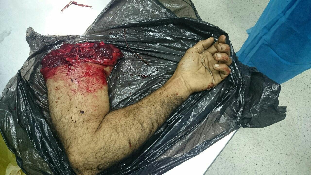 دست قطع شده توسط پزشک بیمارستان امام خمینی (ره) ساری پیوند شد + عکس / +۱۸