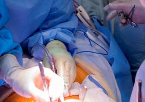 جراحی نادر در بیمارستان خاتم الانبیاء: جراحان توده‌ ۱۸ کیلویی را از شکم زن ۳۶ ساله خارج کردند!