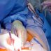 جراحی نادر در بیمارستان خاتم الانبیاء: جراحان توده‌ ۱۸ کیلویی را از شکم زن ۳۶ ساله خارج کردند!