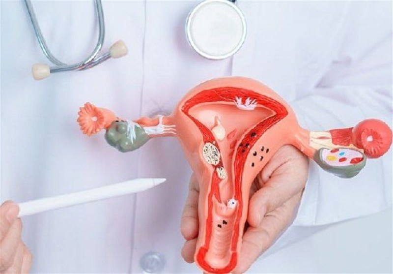 آندومتریوز ۷ تا ۱۰ سال دیرتر تشخیص داده می شود/شیوع آندومتریوز در سنین باروری زنان است